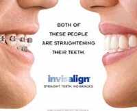 Invisalign instead of braces